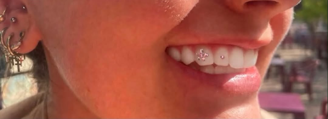 strass-dentaire-3