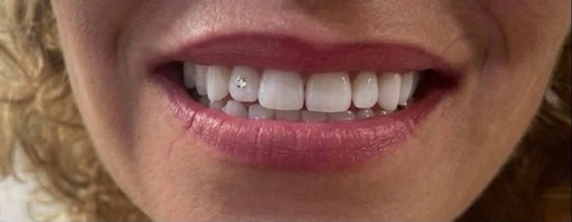 strass-dentaire-5